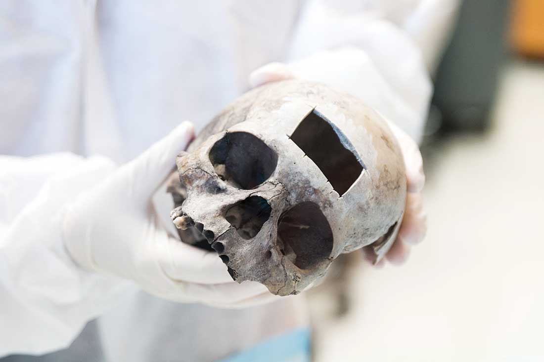 As with this skull, a small section of bone was removed from the Austin skull for DNA testing.